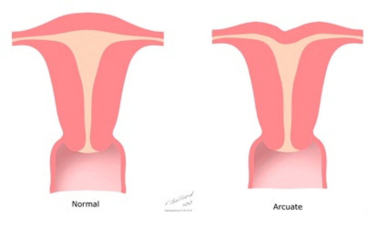 Arcuat Uterus