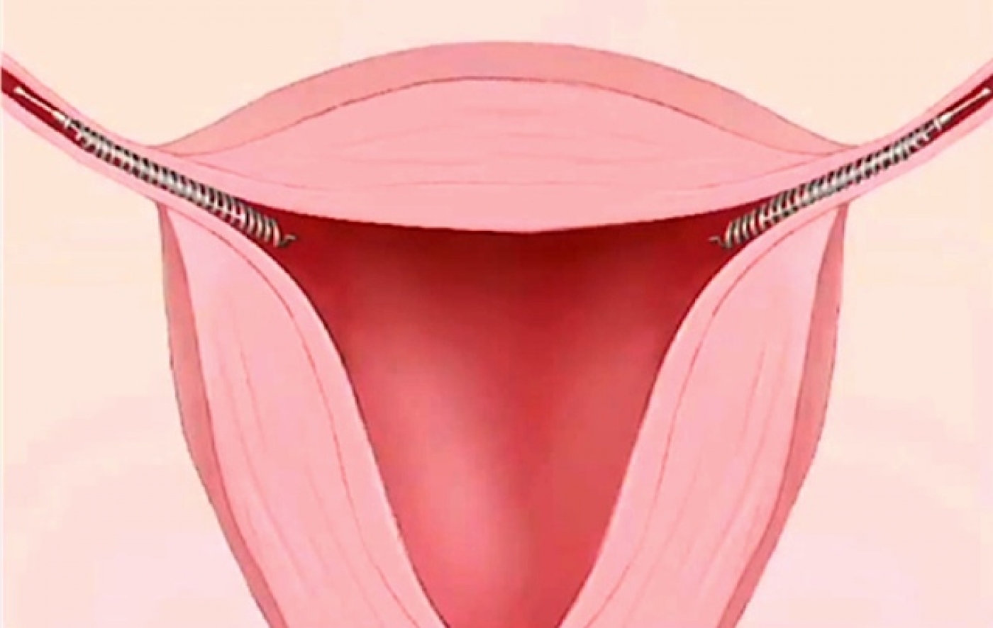 Essure